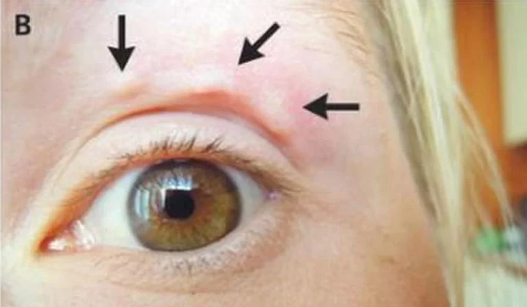 Βλέπετε αυτό το περίεργο «εξόγκωμα» στο μάτι της; «Τρελάθηκαν» οι γιατροί όταν κατάλαβαν τι είναι